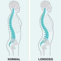 lordosis vs normal posture