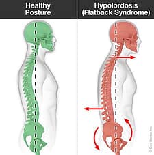 normal vs flatback posture