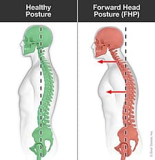 Normal vs Forward head posture
