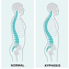 kyphosis vs normal posture