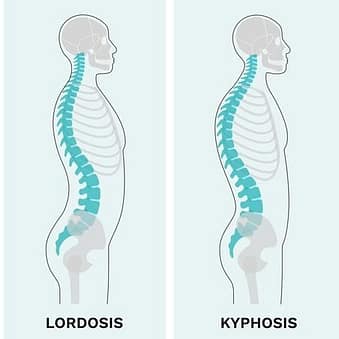 kyphosis vs lordosis
