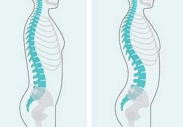 What Is Lordosis?