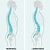 What Is Lordosis?