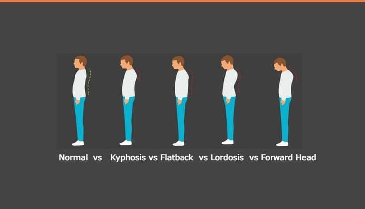 types of Bad Posture